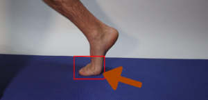 Hyperextension of big toe joint