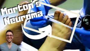 morton neuroma treatment