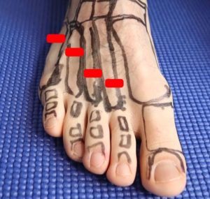 Most common metatarsal stress fracture sites