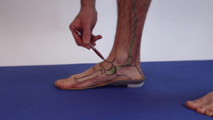 navicular stress fracture orthotics