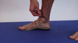 Posterior tibal tendonitis flat foot treatment