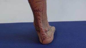 Overpronation of foot and ankle