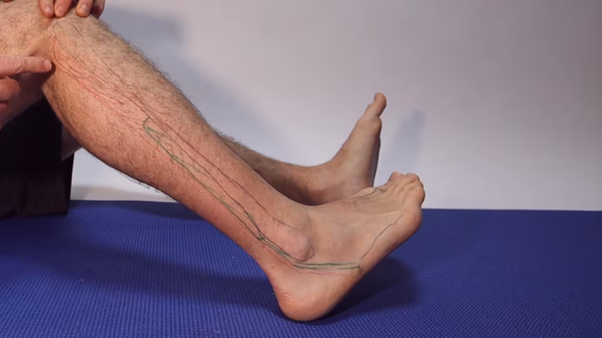 Peroneal Tendons - Balance Foot & Ankle