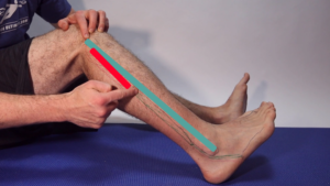 Peroneal tendonitis