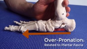 Plantar fasciitis due to overpronation