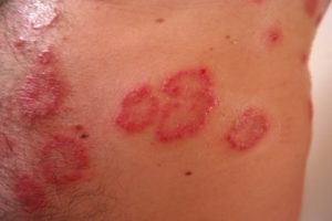 Psoriasis Under The Toenails 3 Skin psoriasis is associated with toenail psoriasis.