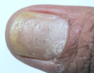 Toenail Psoriasis Treatment