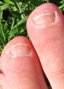Does Wearing Nail Polish Cause Toenail Fungus? 14 white lines leukonychia white lines on toenail