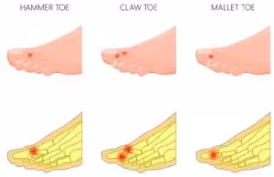 hammer toe deformity treatment