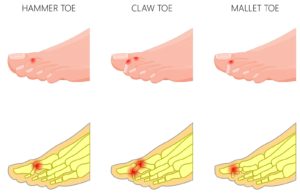 hammer toe deformity treatment