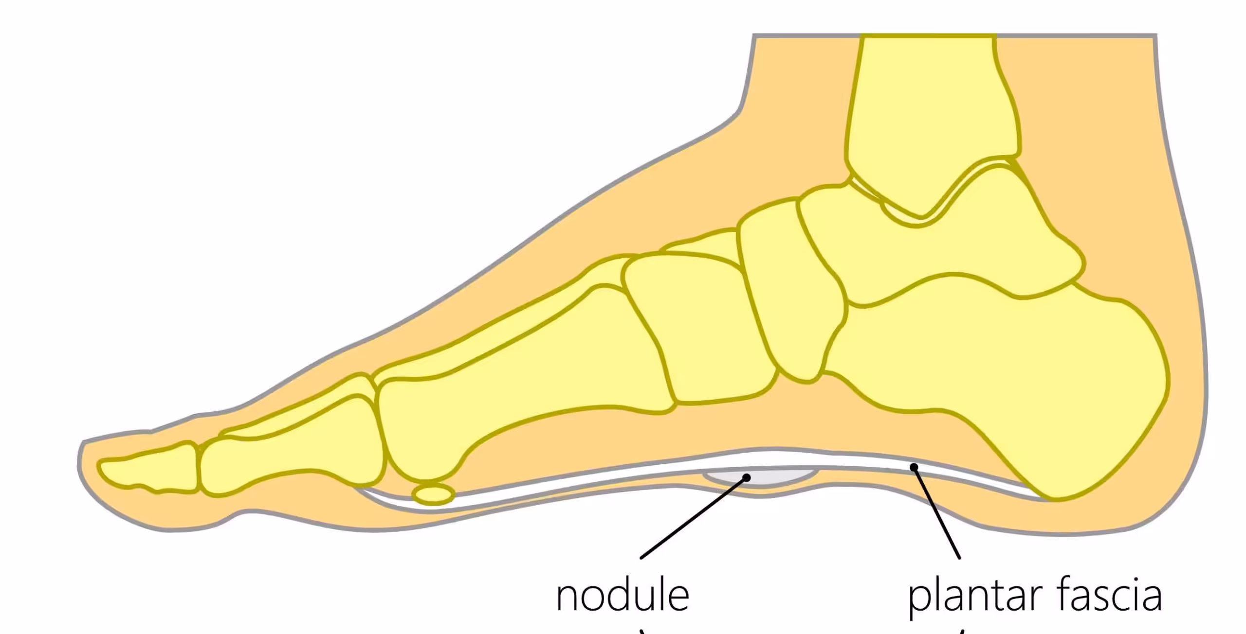 Plantar Fibromatosis Fibroma Lateral View - Balance Foot & Ankle
