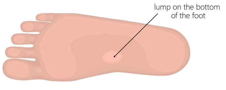 plantar fibromatosis treatment, bump on the bottom of the feet