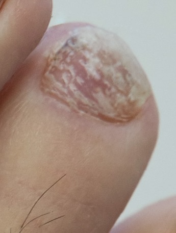 Horizontal white line on the toenail