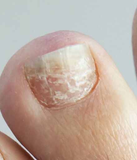White horizontal line or white horizontal ridge on the toenail