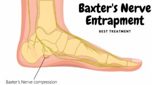 Pinched nerve heel pain at night