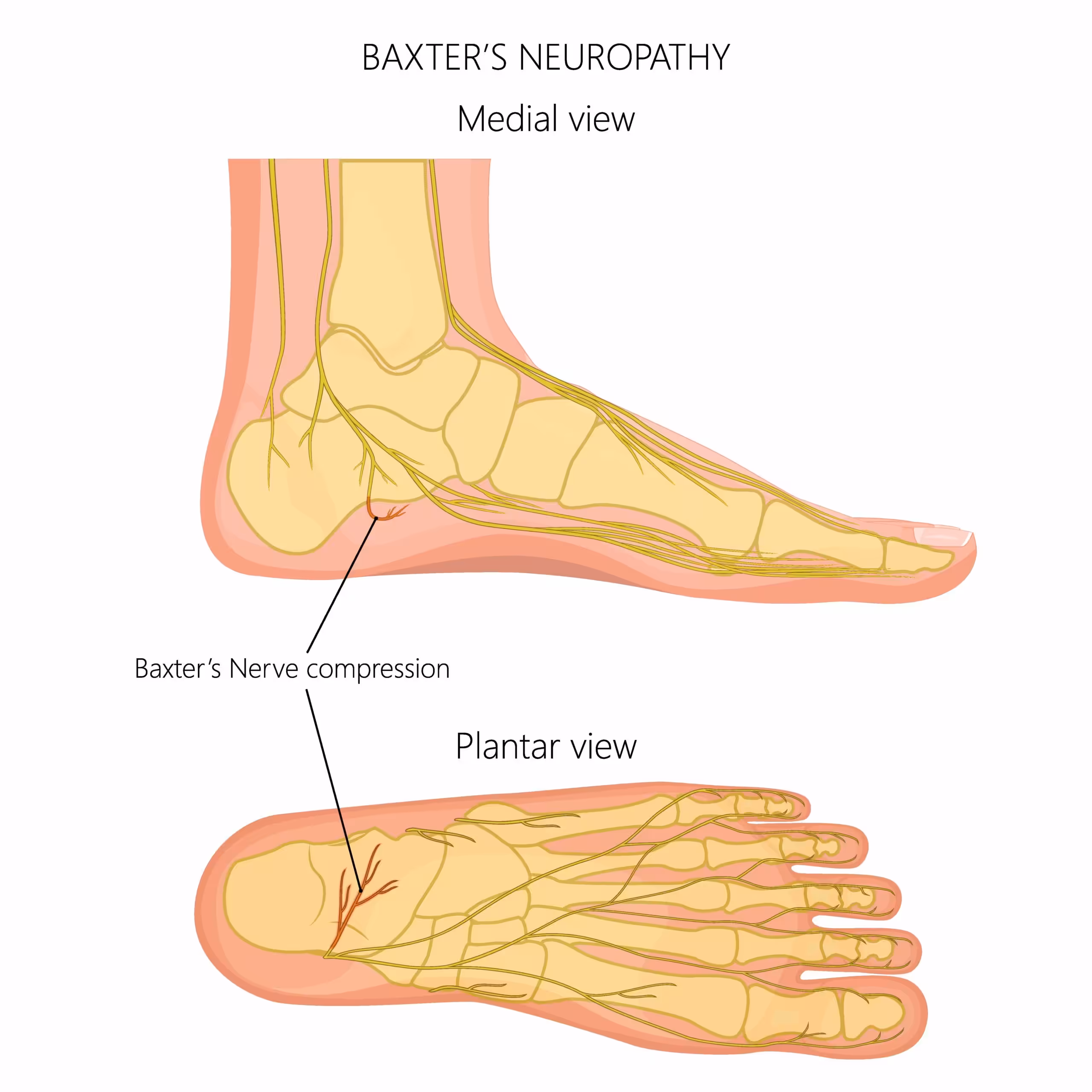 Baxters Nerve Entrapment Pinched Nerve Heel Pain - Balance Foot & Ankle
