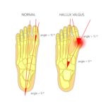 Dislocated Big Toe | 5 Causes, Symptoms & Best Treatment