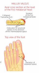 Bunion stages sesamoiditis