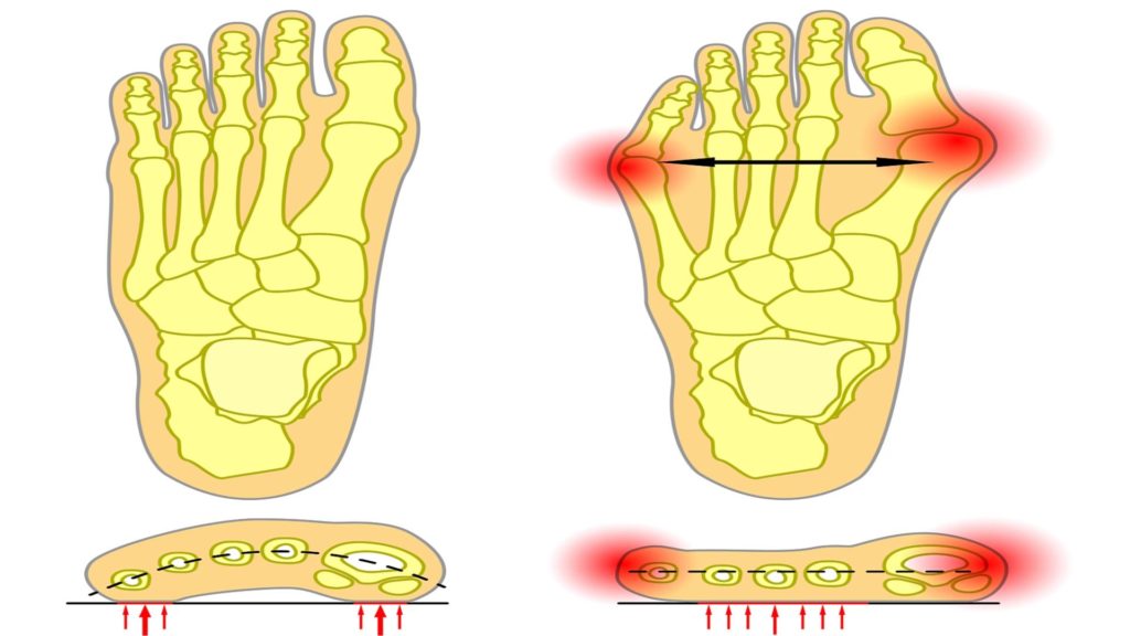 Tailor's bunion pain bunionette