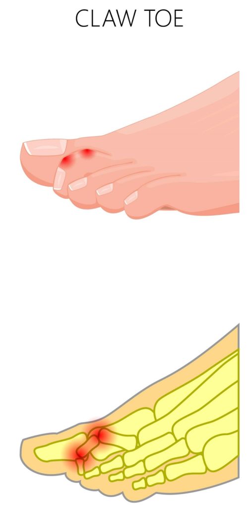 hammer toe and mallet toe