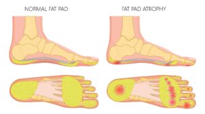 Fat pad atrophy heel pain plantar fasciitis 