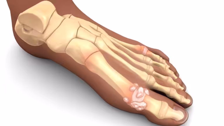 gout doctor, gout podiatrist