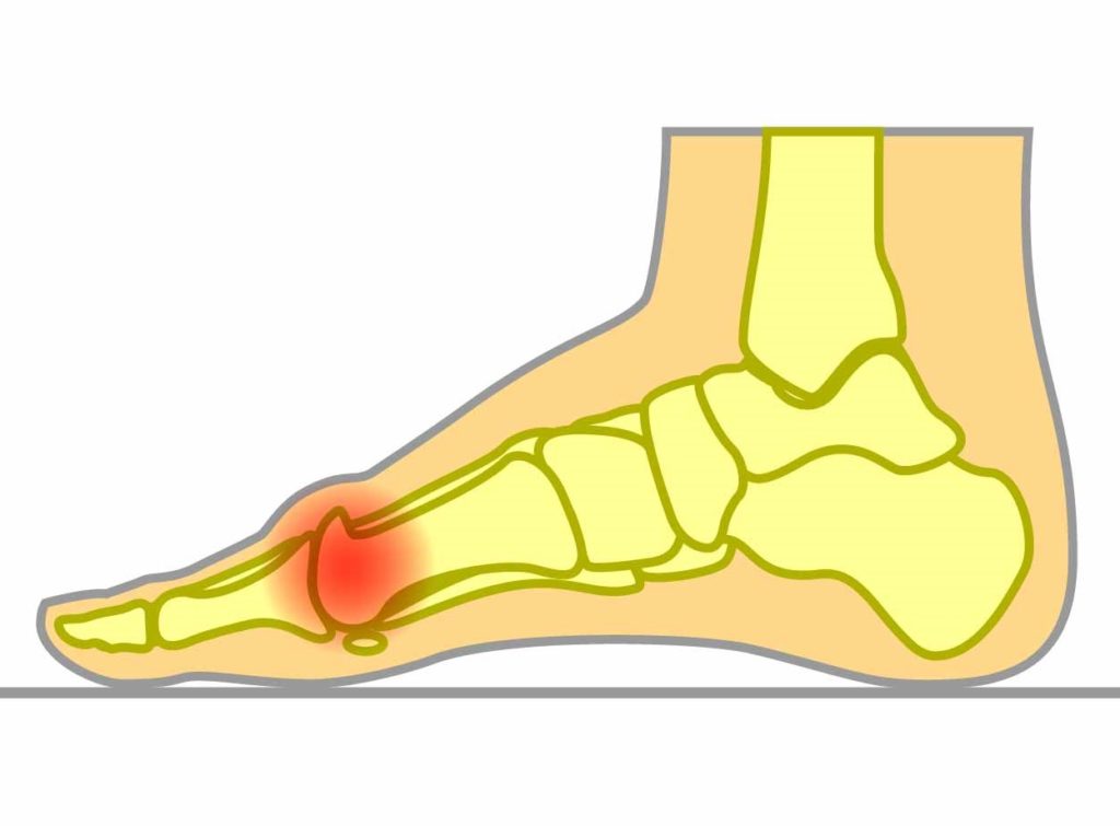bone spurs big toe