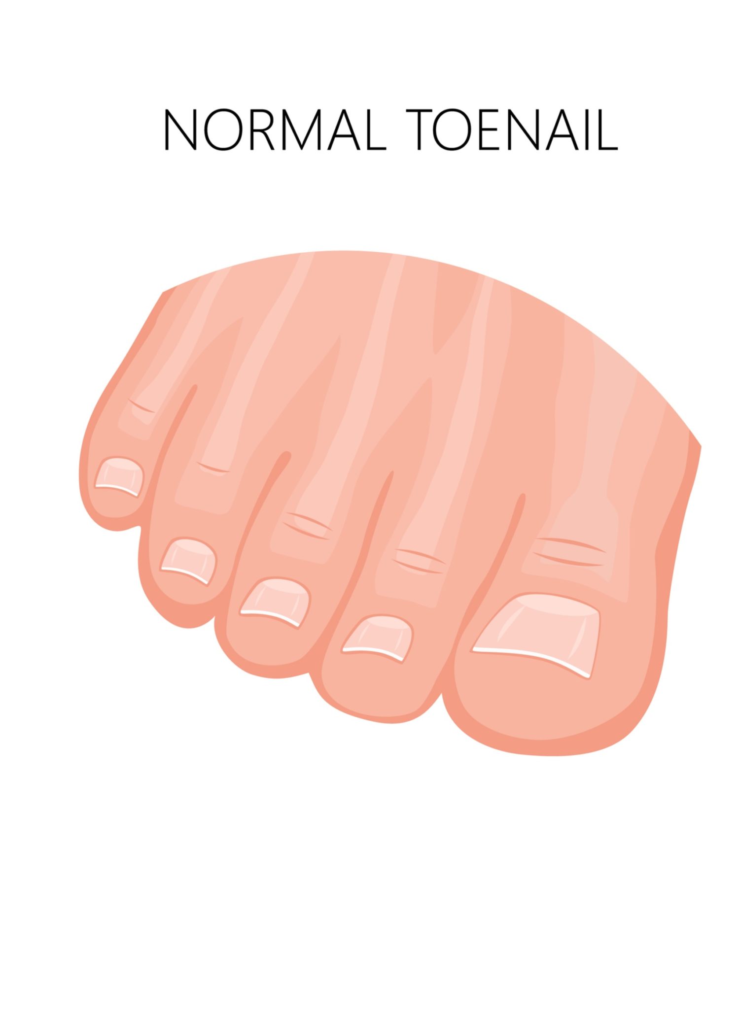 Ingrown toenails normal toenail Balance Foot & Ankle Specialists
