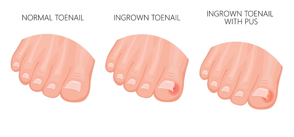 How to fix an ingrown toenail podiatrist treatment