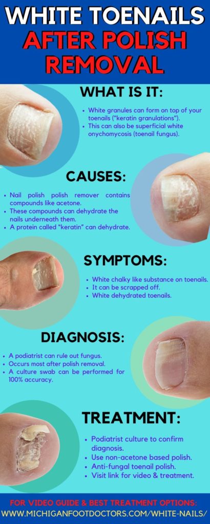 white spots on nail, white toenails after removing polish