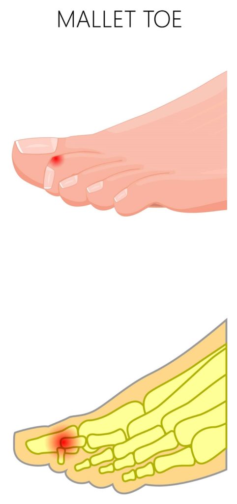 mallet toe pain 2nd toe joint
