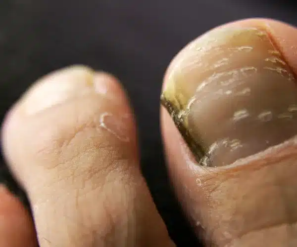 nail pitting treatment