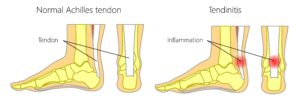 Achilles tendon vs achilles tenonditis