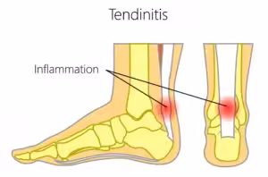 Pain in Back of Heel When Walking 2026: Causes and Treatment