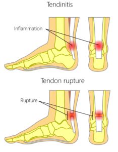 Achilles tendonitis vs achilles tendon rupture