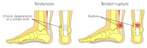 Achilles tendonosis vs Achilles rupture