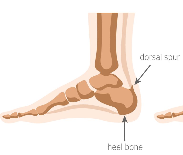 Shockwave therapy plantar fasciitis & heel spur treatment