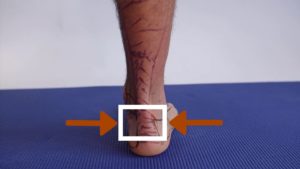 Shoes rubbing back of ankle 4 The back of the heel spur can be related to insertional Achilles tendinitis