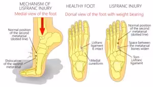 Top of Foot Swollen 2026: Causes and Best Treatment 24 Top of the foot sprain pain fracture