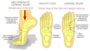 Top of the foot pain fracture