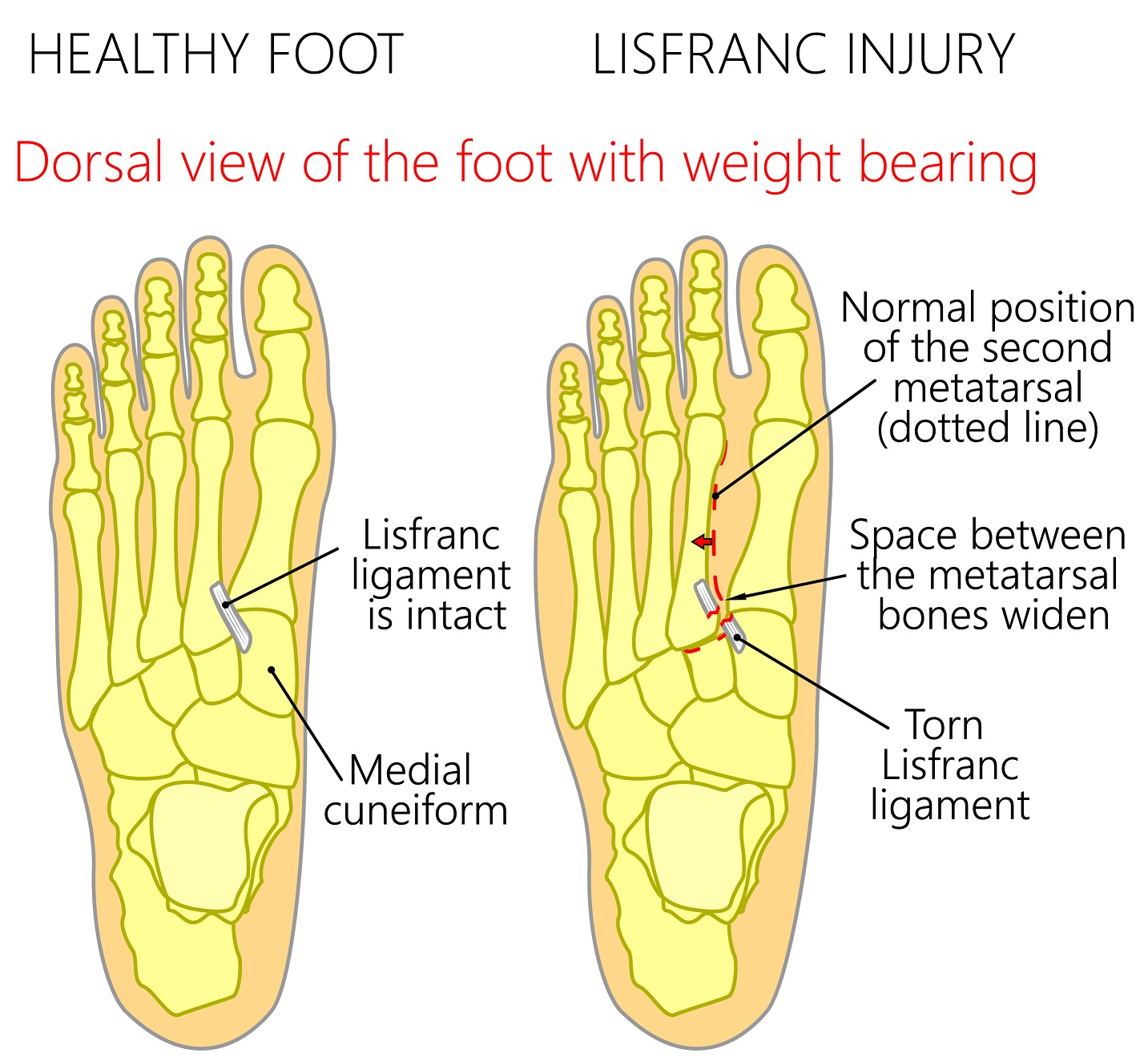 Lisfranc Injury Treatment [Exercises, Rehab & FASTER Recovery Time]