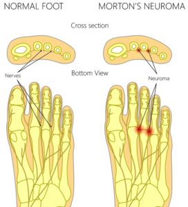 Pain in the sole of the foot near the toes