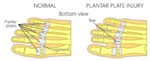 Plantar plate tear injury to the 2nd toe joint