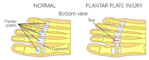 2nd Toe Capsulitis 1 Plantar plate tear injury to the 2nd toe joint
