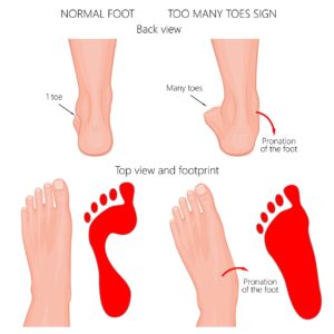 Too many toes sign over pronation