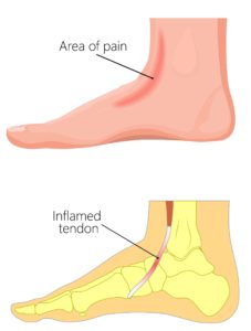 Extensor tendinitis in the foot