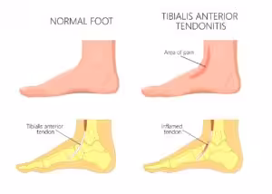 Top of the foot extensor tendinitis