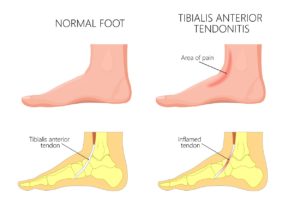 Top of the foot extensor tendinitis