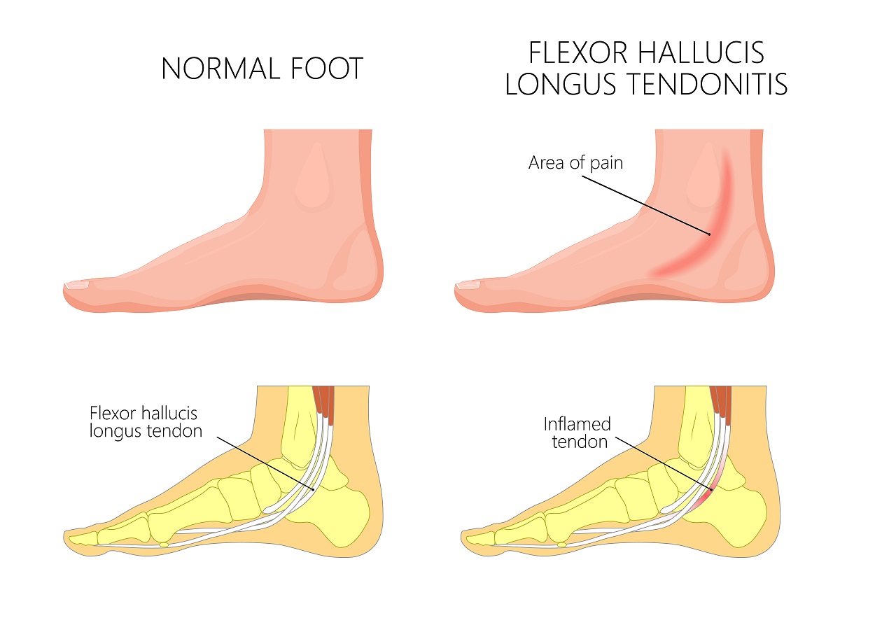 Best Posterior Tibial Tendonitis Brace [Lace Up Ankle u0026 Foot Braces]
