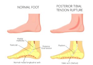 Posterior Tibial Tendonitis Treatment 2